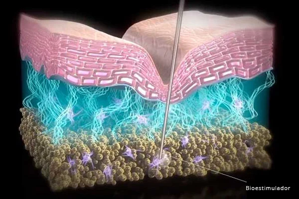 Bioestimulador tópico ou injetável